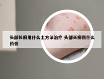 头部长癣用什么土方法治疗 头部长癣用什么药膏