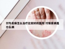 付牛皮癣怎么治疗比较好的医院 付银屑病是什么病