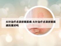 火针治疗点滴状银屑病 火针治疗点滴状银屑病效果好吗