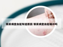 银屑病查血能知道原因 银屑病查血能确诊吗