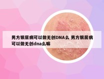 男方银屑病可以做无创DNA么 男方银屑病可以做无创dna么嘛