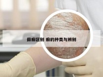 藓癣区别 癣的种类与辨别