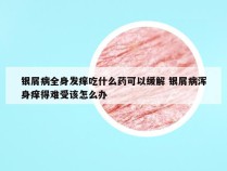 银屑病全身发痒吃什么药可以缓解 银屑病浑身痒得难受该怎么办