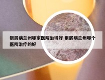 银屑病兰州哪家医院治得好 银屑病兰州哪个医院治疗的好