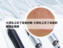 小孩头上长了白色的癣 小孩头上长了白色的癣并且很痒