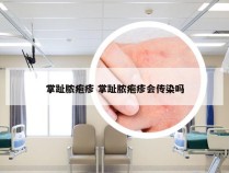 掌趾脓疱疹 掌趾脓疱疹会传染吗