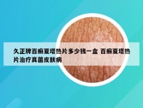 久正牌百癣夏塔热片多少钱一盒 百癣夏塔热片治疗真菌皮肤病