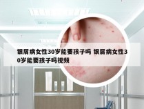 银屑病女性30岁能要孩子吗 银屑病女性30岁能要孩子吗视频