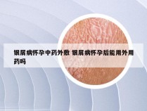 银屑病怀孕中药外敷 银屑病怀孕后能用外用药吗