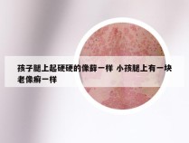 孩子腿上起硬硬的像藓一样 小孩腿上有一块老像癣一样