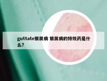 guttate银屑病 银屑病的特效药是什么?