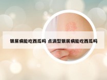 银屑病能吃西瓜吗 点滴型银屑病能吃西瓜吗