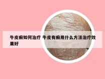 牛皮癣如何治疗 牛皮有癣用什么方法治疗效果好