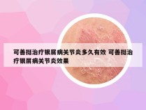 可善挺治疗银屑病关节炎多久有效 可善挺治疗银屑病关节炎效果