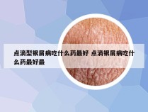 点滴型银屑病吃什么药最好 点滴银屑病吃什么药最好最