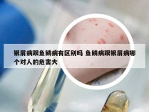 银屑病跟鱼鳞病有区别吗 鱼鳞病跟银屑病哪个对人的危害大