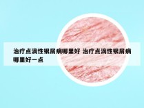 治疗点滴性银屑病哪里好 治疗点滴性银屑病哪里好一点