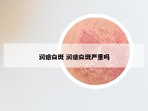 润痣白斑 润痣白斑严重吗