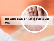 银屑病引起甲变形用什么药 银屑病引起的甲病变