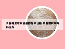 长春哪里看银屑病都择中价格 长春银屑病专科医院