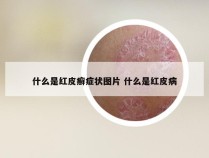 什么是红皮癣症状图片 什么是红皮病