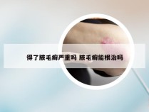 得了腋毛癣严重吗 腋毛癣能根治吗