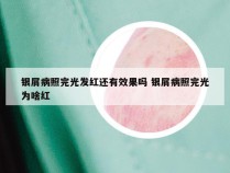 银屑病照完光发红还有效果吗 银屑病照完光为啥红