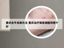 重庆去牛皮癣方法 重庆治疗银屑病医院哪个好