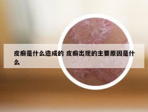 皮癣是什么造成的 皮癣出现的主要原因是什么