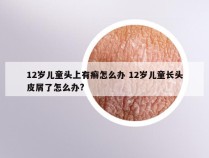 12岁儿童头上有癣怎么办 12岁儿童长头皮屑了怎么办?