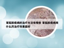 掌跖脓疱病的治疗方法有哪些 掌跖脓疱病用什么药治疗效果最好