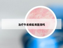 治疗牛皮癣能用医保吗