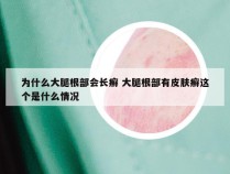 为什么大腿根部会长癣 大腿根部有皮肤癣这个是什么情况