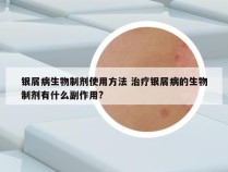 银屑病生物制剂使用方法 治疗银屑病的生物制剂有什么副作用?