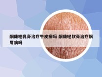 酮康唑乳膏治疗牛皮癣吗 酮康唑软膏治疗银屑病吗