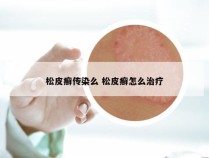 松皮癣传染么 松皮癣怎么治疗