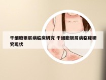 干细胞银屑病临床研究 干细胞银屑病临床研究现状