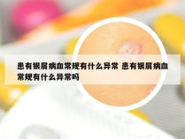 患有银屑病血常规有什么异常 患有银屑病血常规有什么异常吗