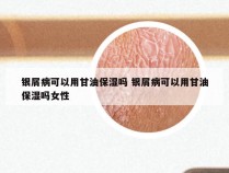 银屑病可以用甘油保湿吗 银屑病可以用甘油保湿吗女性