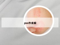 pso牛皮癣