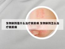 生物制剂是什么治疗银屑病 生物制剂怎么治疗银屑病