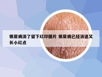 银屑病消了留下红印图片 银屑病已经消退又长小红点