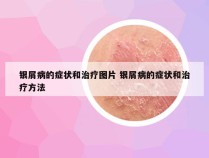 银屑病的症状和治疗图片 银屑病的症状和治疗方法