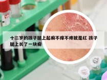 十二岁的孩子腿上起癣不痒不疼就是红 孩子腿上长了一块癣