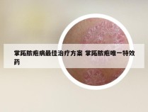 掌跖脓疱病最佳治疗方案 掌跖脓疱唯一特效药