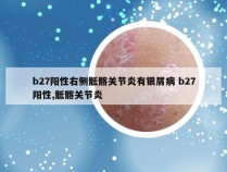 b27阳性右侧骶髂关节炎有银屑病 b27阳性,骶髂关节炎