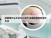 皮癣用什么方法可以治好 皮癣的症状和治疗方法