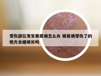 受伤部位发生银屑病怎么办 银屑病受伤了的地方会继续长吗