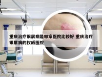 重庆治疗银屑病是哪家医院比较好 重庆治疗银屑病的权威医院