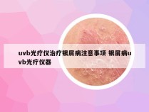 uvb光疗仪治疗银屑病注意事项 银屑病uvb光疗仪器